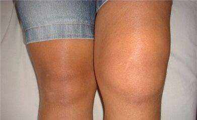 Las causas de la artrosis de la articulación de la rodilla