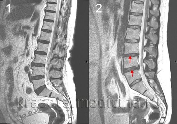 Osteocondrosis de la columna