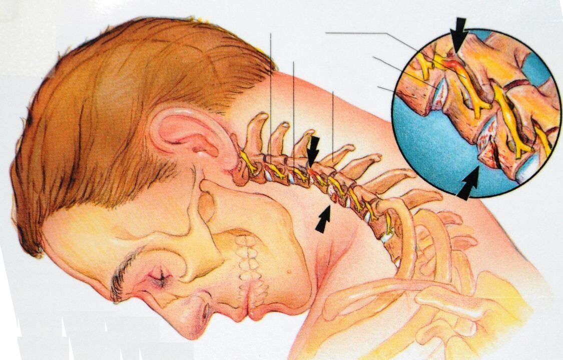 Osteocondrosis de la región cervical